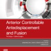 Anterior Controllable Antedisplacement and Fusion (ACAF) - 1st Edition