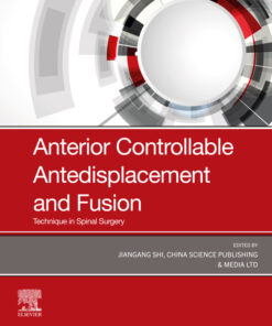Anterior Controllable Antedisplacement and Fusion (ACAF) - 1st Edition