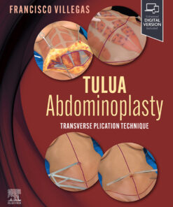 TULUA Abdominoplasty