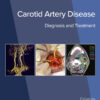 Carotid Artery Disease