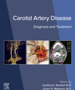 Carotid Artery Disease