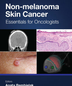 Non-melanoma Skin Cancer - 1st Edition