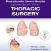 Massachusetts General Hospital Illustrated Tips and Tricks in Thoracic Surgery - 1st Edition